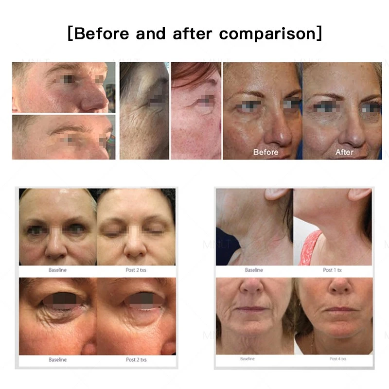 3 in 1 Plasma Machine – Multi-Functional Skin Revival & Anti-Aging Solution