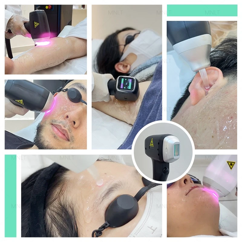 Diode Laser Hair Removal Machine Looking For Dealer